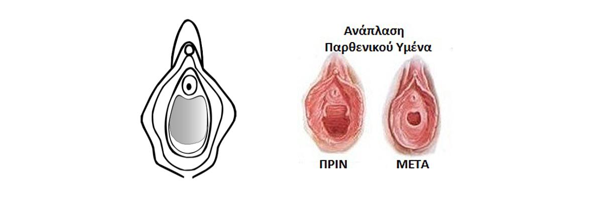 anaplasi ymena